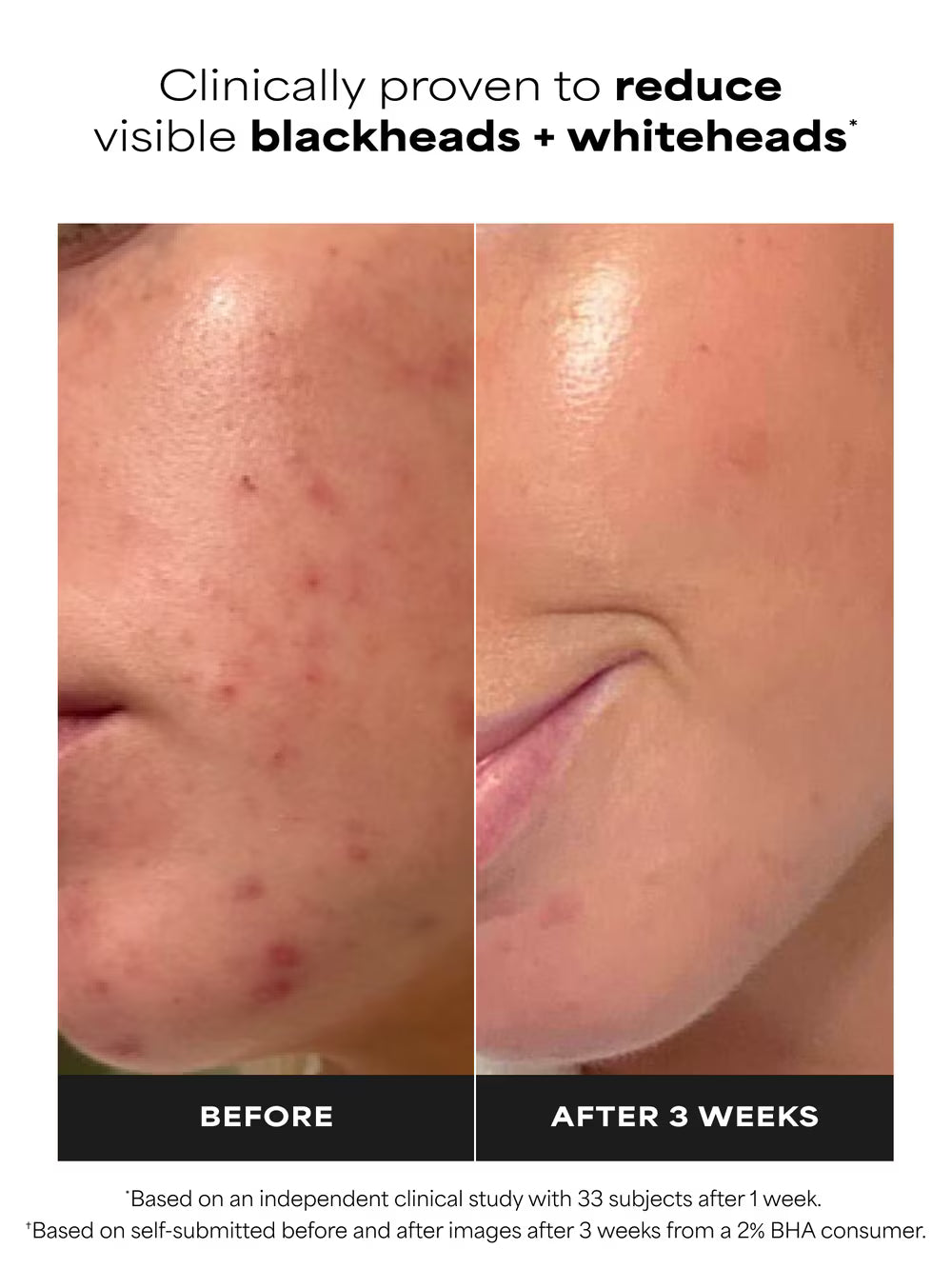 Paula’s Choice
2% BHA Liquid Exfoliant 🖤