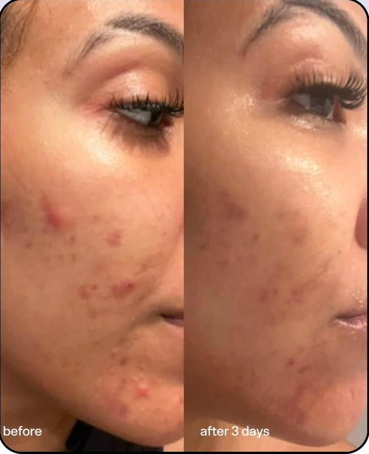 Bubble Super Clear
Acne Treating Serum
2% Salicylic Acid 30 ml ♥️
